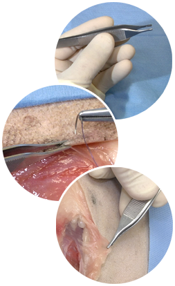A series of three images depicting the thumb forcep instrument.